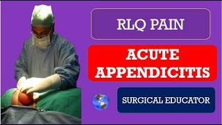 ACUTE APPENDICITIS How To DIAGNOSE amp TREAT  RLQ PAIN [upl. by Reviere314]