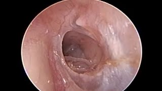 ENT Endoscopy  Chronic Allergic Rhinosinusitis with Ethmoid Polyp resulting into Ear peforation [upl. by Biggs]