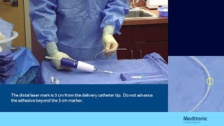 Treatment for varicose veins  VenaSeal Closure System  Medtronic India [upl. by Adore]