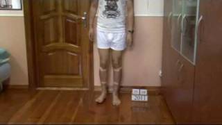 Bow legs correction treatment  China patient experience [upl. by Sivi237]