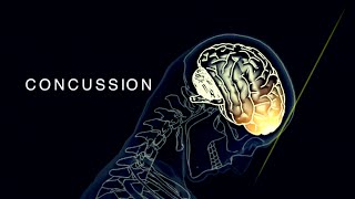 Concussion In Sport  Sport Medicine Physical Education PE [upl. by Notgnirrac]