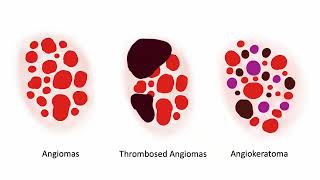 Angiomas and variants  Dr C Navarrete Dechent [upl. by Cotsen]