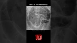 Abdominal Xray Question 4 [upl. by Anaitsirhc]