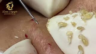 Blackheads extraction 406  Loan Nguyen [upl. by Rosalba736]