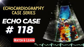 ECHO CASE 118  Echocardiography For Beginners  Echo Cases [upl. by Wolpert]