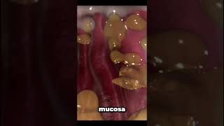 helicobacter pylori infection [upl. by Riki152]