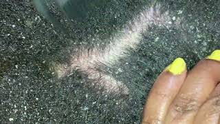 Dandruff scratching  part 2 [upl. by Harday]