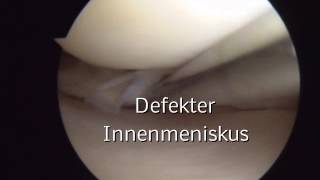 Orthodoctv  Orthpädie am Gasteig  Arthroskopie Knie Meniskusschaden arthroscopic knee surgery [upl. by Nirad84]