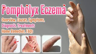 Pompholyx eczema causes symptoms diagnosis treatment home remedies FAQ  Dyshidrotic eczema [upl. by Tnayrb]