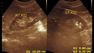 Renal Calculi  Cortical cyst  Cyst wall calcification  Milk of calcium [upl. by Akiemahs]