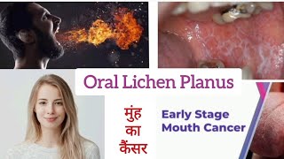 Oral Lichen Planus  Early Stage Mouth Cancer  मुंह में घाव  मुंह में छाले lichenplanus cancer [upl. by Enilec]