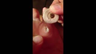 Nasty and gross plantar wart on bottom of foot [upl. by Celestyna]