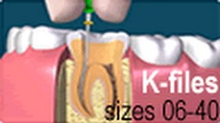 Dental Endo Hand Use Root Canal K Files [upl. by Hillari]