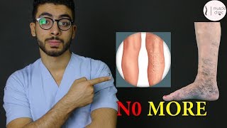 ما هى دوالى الساقين ؟  علاج مشكلة الدوالى نهائيا varicose veins treatment [upl. by Mada219]