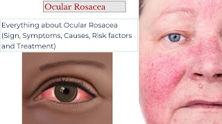 Ocular Rosacea Sign Symptoms Risk factors and treatment [upl. by Atnauqahs383]