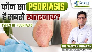 Psoriasis कितने तरह के होते हैं कैसे होगा इनका इलाज  Psoriasis Treatment India [upl. by Noelc]