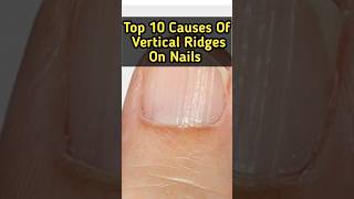 Do you Have vertical ridges on nails shorts youtubeshorts top10 [upl. by Namijneb]