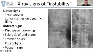 What might indicate a mobile listhesis in the lumbar spine [upl. by Dippold472]