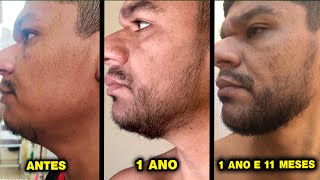 ELE USOU 5 TIPOS DE MINOXIDIL Kirkland Foligain Pant Kirkland em espuma e Minoxidil em cápsulas [upl. by Aikemet]