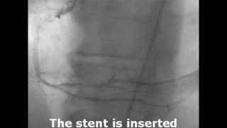 What A Diffenence A Stent Makes [upl. by Lochner375]