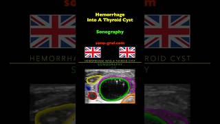 Sonography  Hemorrhage Into A Thyroid Cyst [upl. by Lee]