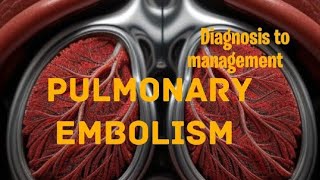 Pulmonary embolism  From Diagnosis to management [upl. by Ylevol]