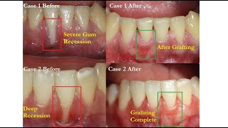 Gum Grafting for Gum Recession  Seoul Guide Medical [upl. by Knobloch]