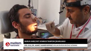 Burun Ameliyatı Sonrası Tampon ÇıkarılmasıYrd Doc Dr Ahmet Hamdi Kepekçi [upl. by Etireuqram]