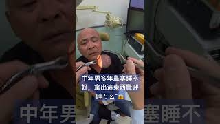 鼻塞可以輕鬆解除Nasal obstruction cured with simple treatment [upl. by Merrile565]