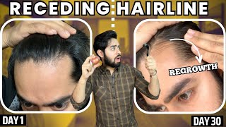 सिर्फ 1 महीने मैं RECEDING HAIRLINE REGROW करो  30 days HAIRLINE REGROWTH challenge [upl. by Alrahs]