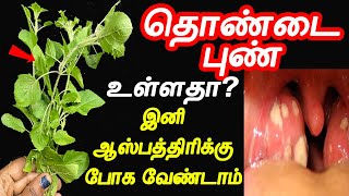 10இலையை கொதிக்க வைத்து 2முறை குடிங்க  thondai pun tamil maruthuvam  Throat Pain  thondai vali [upl. by Earla]