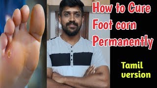 கால் ஆணி Foot Corn  கால் ஆணி செரியாக permanent cure  Tamil  Lohisya media [upl. by Notneiuq]