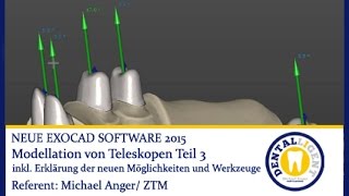 DENTAL  EXOCAD 2015  Modellation von Teleskopen TEIL 3 by Michael Anger [upl. by Rekrap]