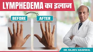 How to Manage Lymphedema Effective Treatment Options हिंदी में  Sentinel Lymph Node Biopsy [upl. by Jeffy]