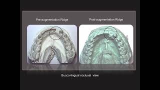 Ridge augmentation with BMP2  26 with implant placement [upl. by Rudich]