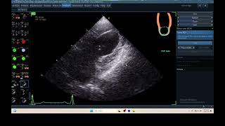 IQ 306 AFI LA ECHOPAC ANALYSIS HEPATOMA PTE ECHOCARDIOGRAPHY [upl. by Ardnac]