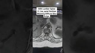 MRI Lumber Spine Sequence t1tseaxial Section Showing Diffuse Disc Bulge beginners anatomy [upl. by Noll]