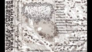 Acromegalia  Continuous Infection Full Tape [upl. by Aicele973]