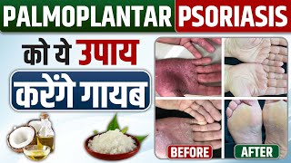 Skin home remedies  Palmoplantar psoriasis treatment  Palmoplantar Psoriasis का घरेलू इलाज [upl. by Hirza]