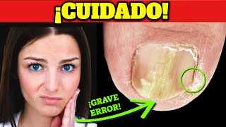 ¡Lo mejor para PREVENIR CURAR y ELIMINAR los HONGOS en las uñas PARA SIEMPRE [upl. by Naimed]