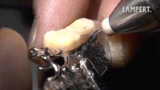 PUK dental welding  very low heat development [upl. by Dusa]