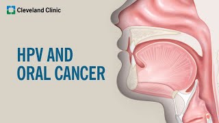 What Is HPVRelated Oral Cancer [upl. by Minnie843]