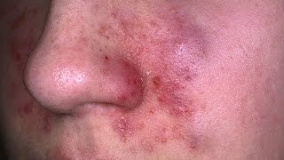 Eczema Dermatitis Treatment  The Benefits of Treating Eczema with Home Remedies [upl. by Lahtnero]