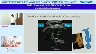 Ultrasonogorafik Fetal Kardiyak Tarama  DoçDr Hakan Timur [upl. by Gibun]