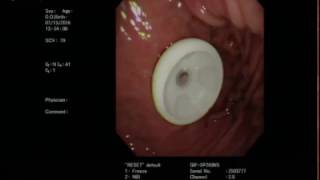 內視鏡胃造口術 Endoscopic Gastrostomy with Ultrathin Endoscope [upl. by Gladi]