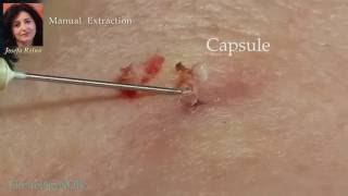 Josefa Removal of a Sebaceous Cyst gigantic blackhead [upl. by Clemmie]