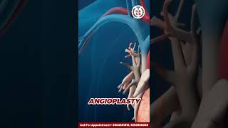 Angioplasty Explained Restoring Heart Health and Saving Lives  Dr Neeraj Varyani  8604601010 [upl. by Adnoyek]