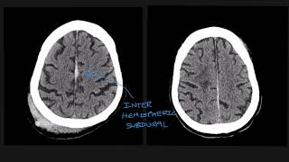 Understanding the different types of traumatic brain bleed on CT scans [upl. by Aifas]