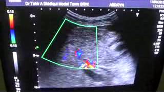 CIRRHOTIC LIVER with SOLID MASSES PORTAL VEIN THROMBOSIS ASCITES [upl. by Aleen]