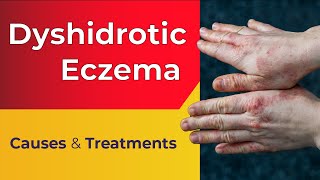 What is Dyshidrotic Eczema  Overview Causes Treatments [upl. by Eem738]